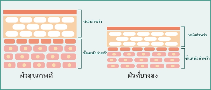 รอยคล้ำสีน้ำเงิน ①: ผิวบางลง