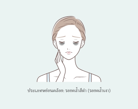 รอยคล้ำสีดำ (รอยคล้ำเงา): ความหย่อนคล้อย