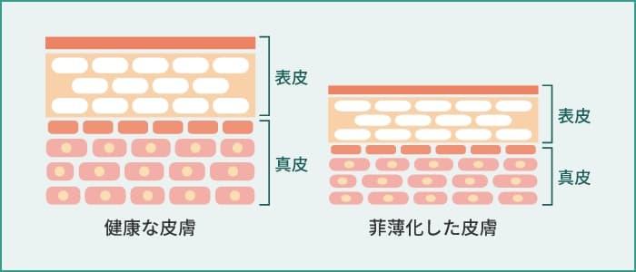 【 青くま① 】 皮膚の菲薄化（薄くなる）